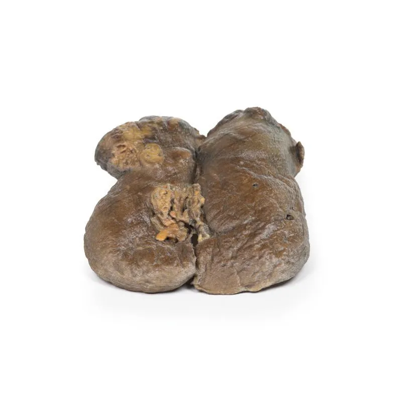 3D Printed Renal Cell Carcinoma